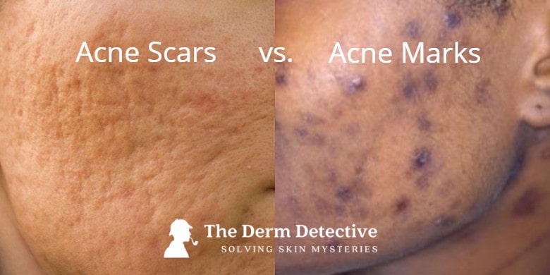 Acne-Scars-vs-Acne-Marks-vF-min