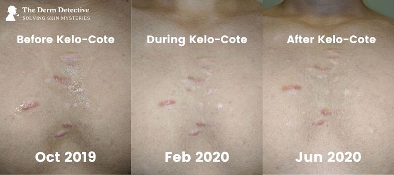 Chest Keloids Kelo-Cote