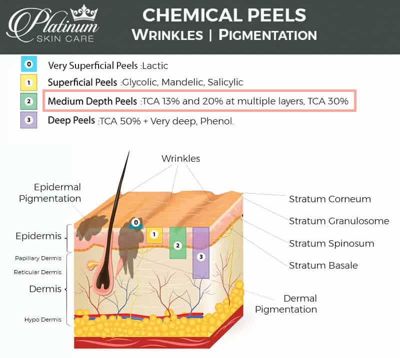 Depth-of-Chemical-Peel-Penetration-Annotated
