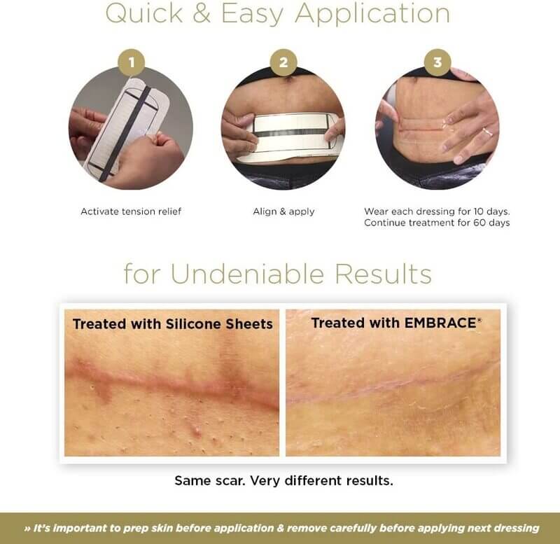 Embrace Active Scar Defense for Tummy Tuck Scars Ad 2