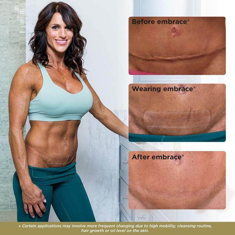 Embrace Active Scar Defense for Tummy Tuck Scars Ad