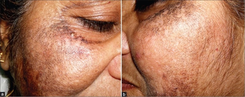 Exogenous-Ochronosis-Case-in-50-Year-Old-Indian-Woman