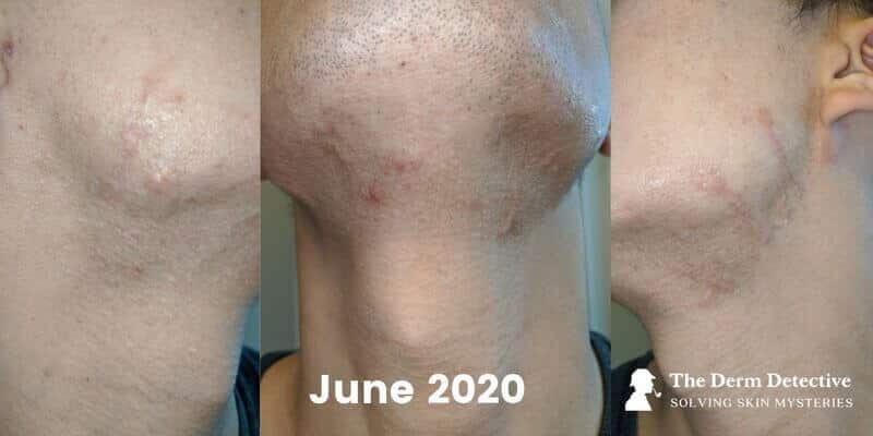 Facial Hypertrophic Scars on June 14, 2020